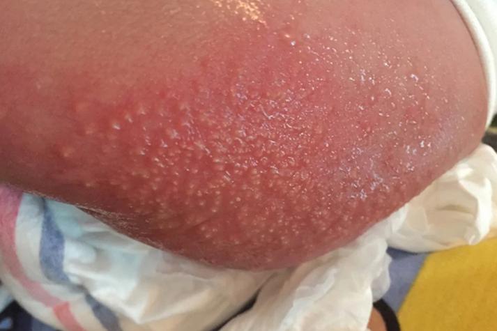 新生儿屁股眼出现湿疹，是什么原因导致的？应该如何正确处理和护理呢？-第2张图片-郑州医学网