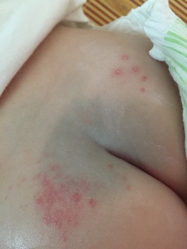 新生儿屁股眼出现湿疹，是什么原因导致的？应该如何正确处理和护理呢？-第3张图片-郑州医学网