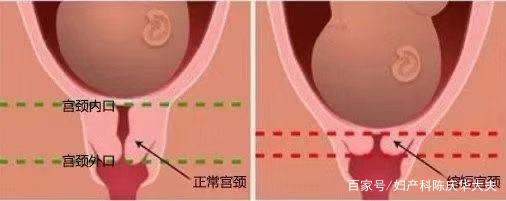 孕期宫颈短怎么导致的-第2张图片-郑州医学网