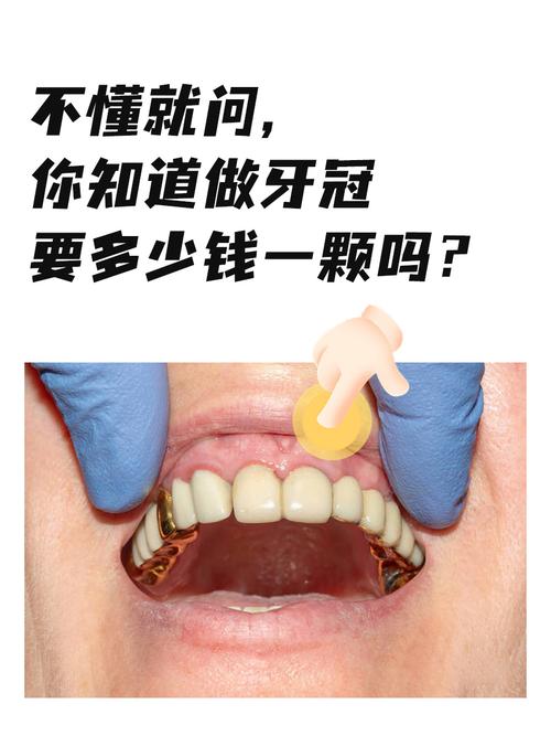 儿童做牙冠一颗费用是多少？不同材质、地区差异大吗？-第1张图片-郑州医学网