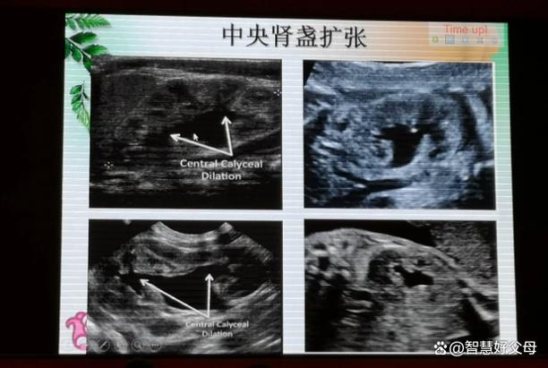 新生儿双肾分离是异常信号吗？需要干预吗？-第2张图片-郑州医学网