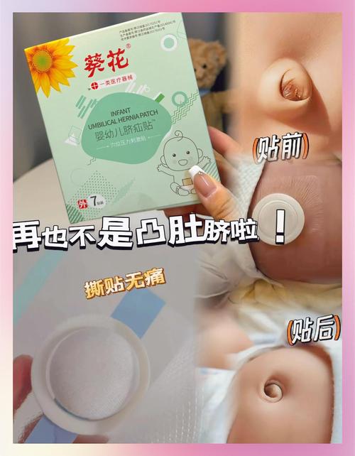 新生儿脐疝应该怎么处理？需要手术吗？日常护理要注意什么？-第2张图片-郑州医学网
