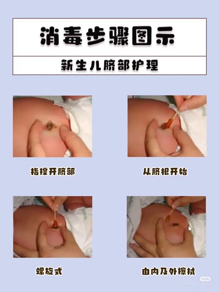 新生儿脐疝应该怎么处理？需要手术吗？日常护理要注意什么？-第3张图片-郑州医学网