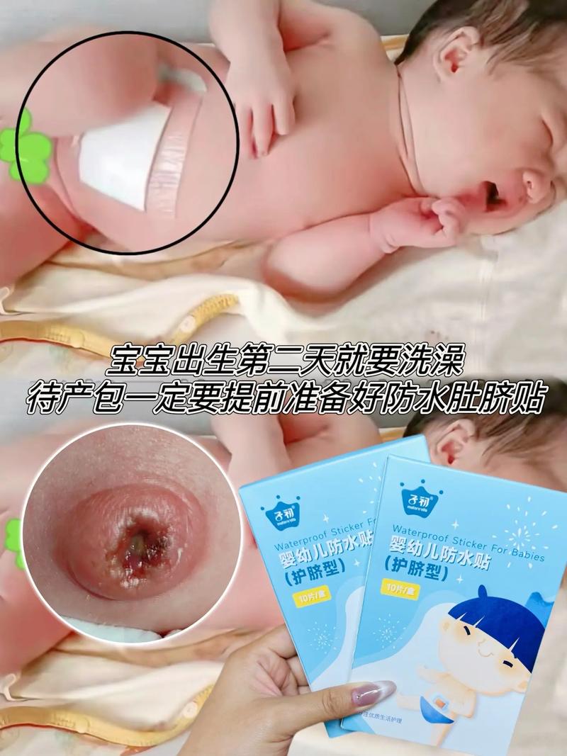 新生儿脐炎住院一般需要几天？影响因素有哪些？-第3张图片-郑州医学网