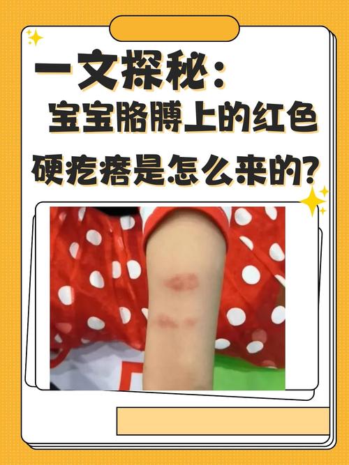 新生儿头颅血肿变硬后多久能吸收？需要特殊处理吗？-第1张图片-郑州医学网