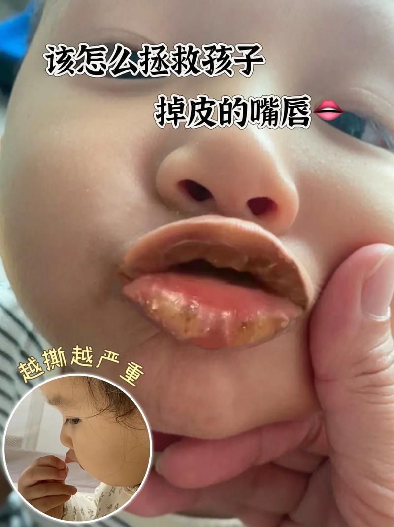 新生儿嘴巴干是缺水还是生病了?家长该怎么判断和应对?-第3张图片-郑州医学网 新生儿嘴巴干是缺水还是生病了?家长该怎么判断和应对?-第3张图片-郑州医学网