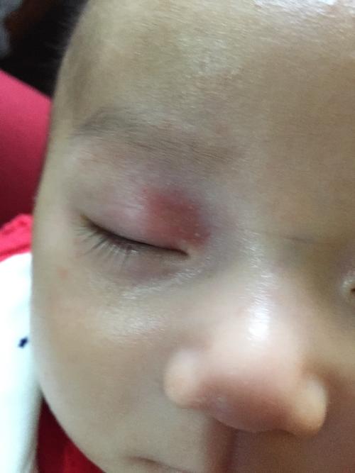 新生儿眼皮红印是什么原因？需要担心吗？-第2张图片-郑州医学网