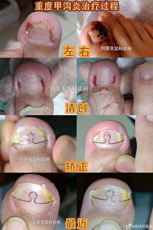 孕期甲沟炎发作红肿疼痛，该如何安全处理才不影响胎儿健康？-第1张图片-郑州医学网