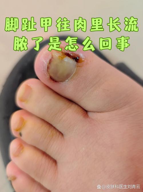 孕期甲沟炎发作红肿疼痛，该如何安全处理才不影响胎儿健康？-第2张图片-郑州医学网