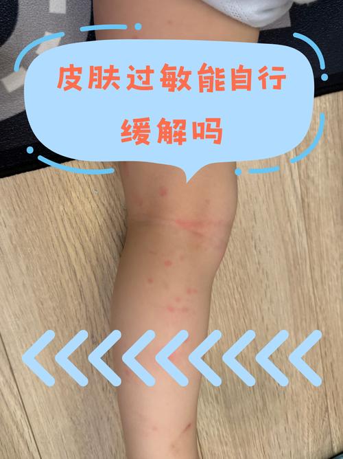 备孕期间服用扑尔敏会影响胎儿健康吗?-第1张图片-郑州医学网 备孕期间服用扑尔敏会影响胎儿健康吗?-第1张图片-郑州医学网