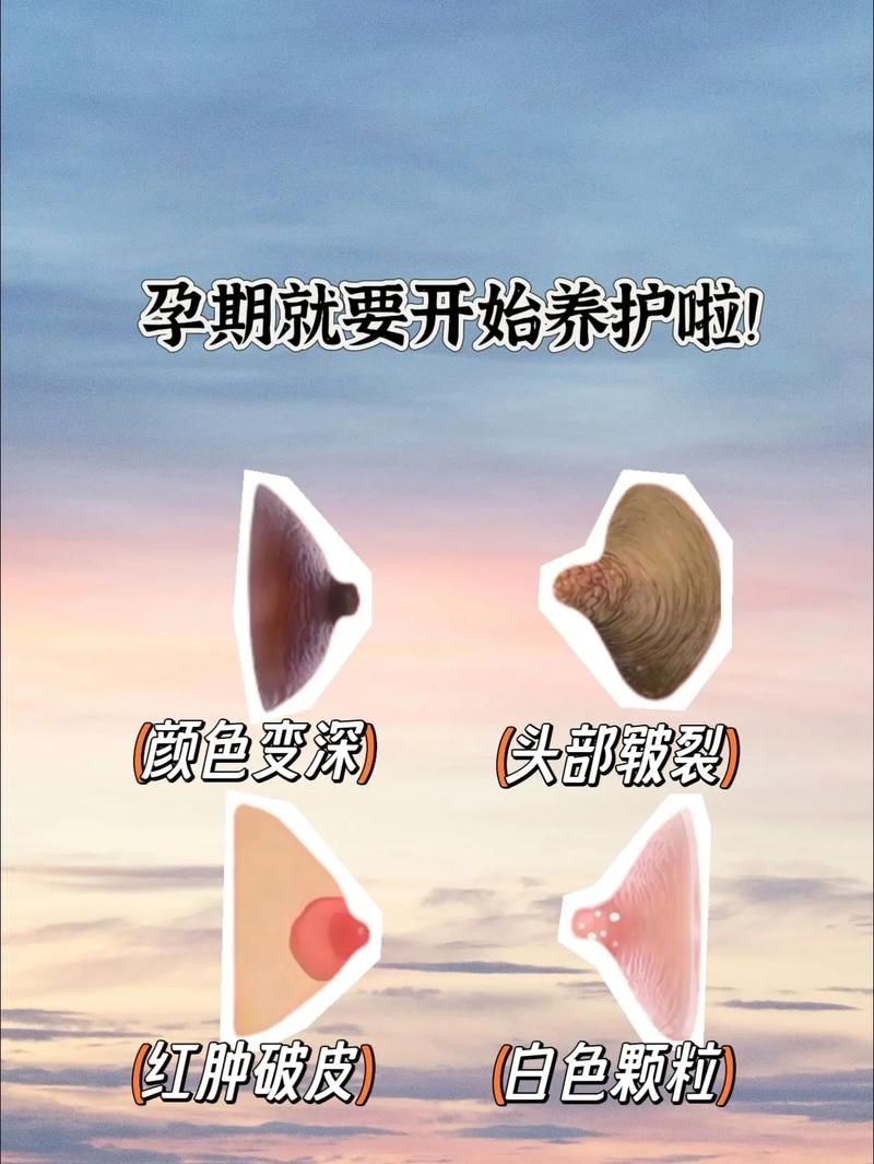 孕期乳头结痂到底要不要清理？正确处理方法是什么？-第3张图片-郑州医学网