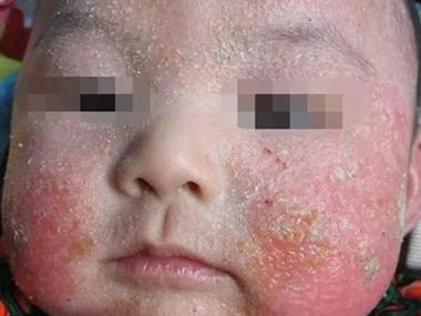 新生儿脸上结痂是正常现象吗？该如何正确护理避免感染？-第1张图片-郑州医学网