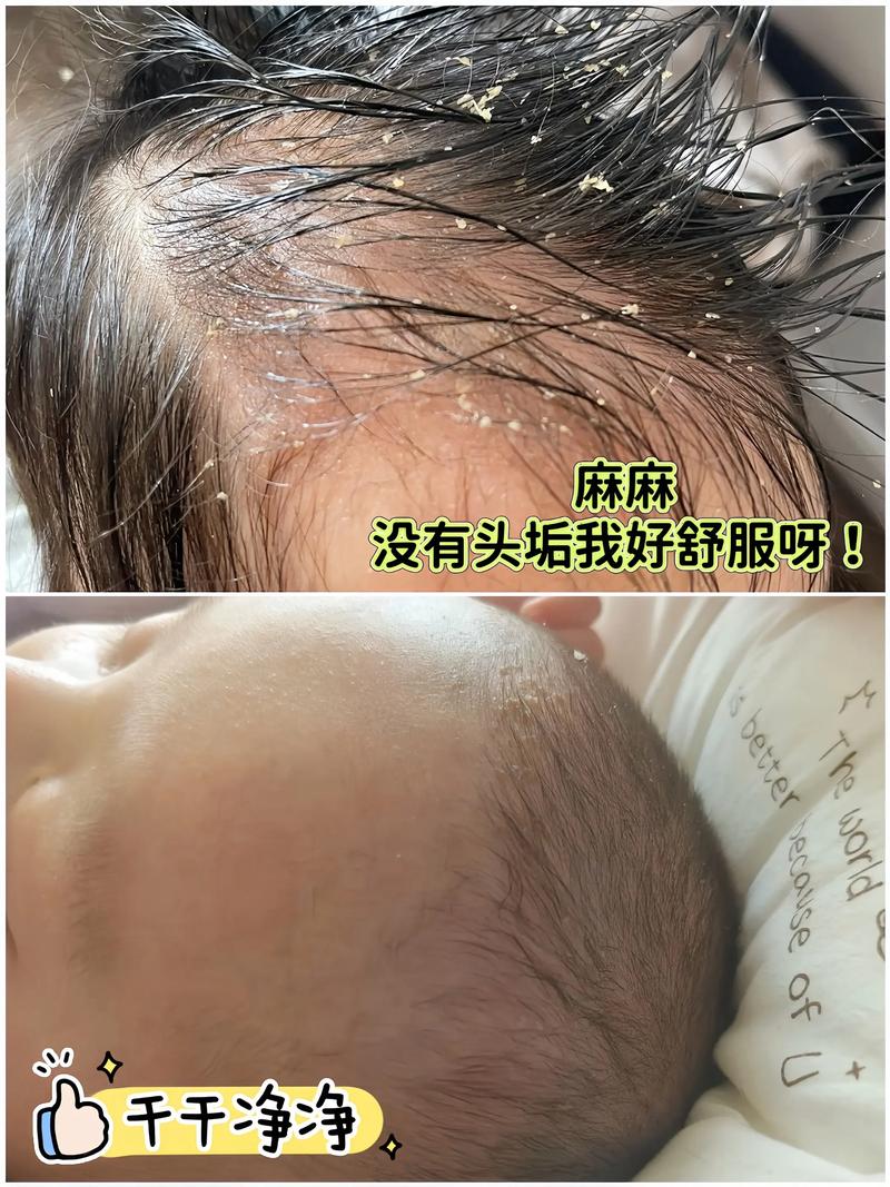 新生儿脸上结痂是正常现象吗？该如何正确护理避免感染？-第2张图片-郑州医学网