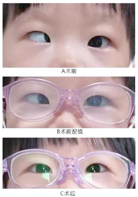 新生儿斗鸡眼是正常现象还是需要矫正？家长该如何科学应对？-第1张图片-郑州医学网