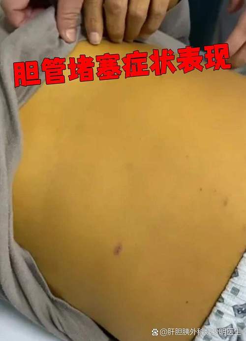新生儿胆管闭塞存活率究竟有多高？手术治疗后长期生存质量如何保障？-第1张图片-郑州医学网