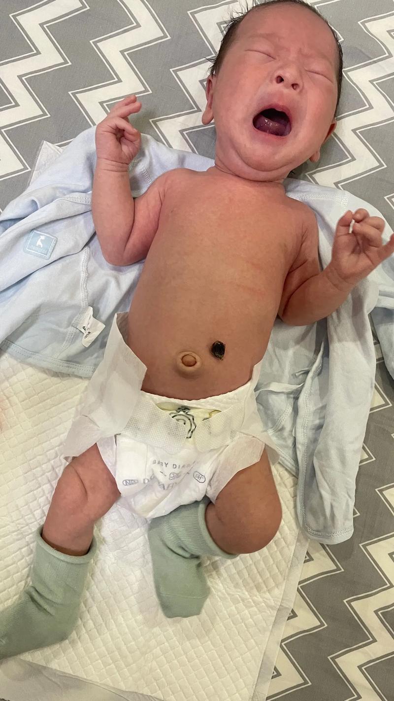 新生儿肚脐脱落后图片显示正常还是异常？如何判断护理是否得当？-第1张图片-郑州医学网