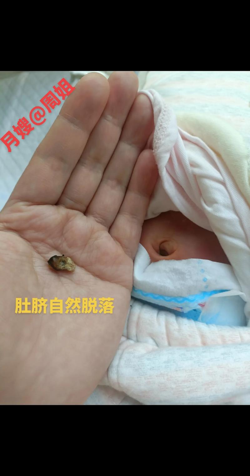新生儿肚脐脱落后图片显示正常还是异常？如何判断护理是否得当？-第2张图片-郑州医学网