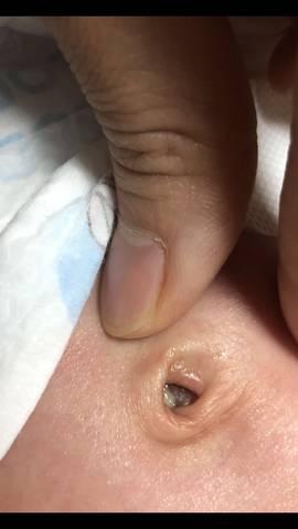 新生儿脐带脱落的征兆-第2张图片-郑州医学网