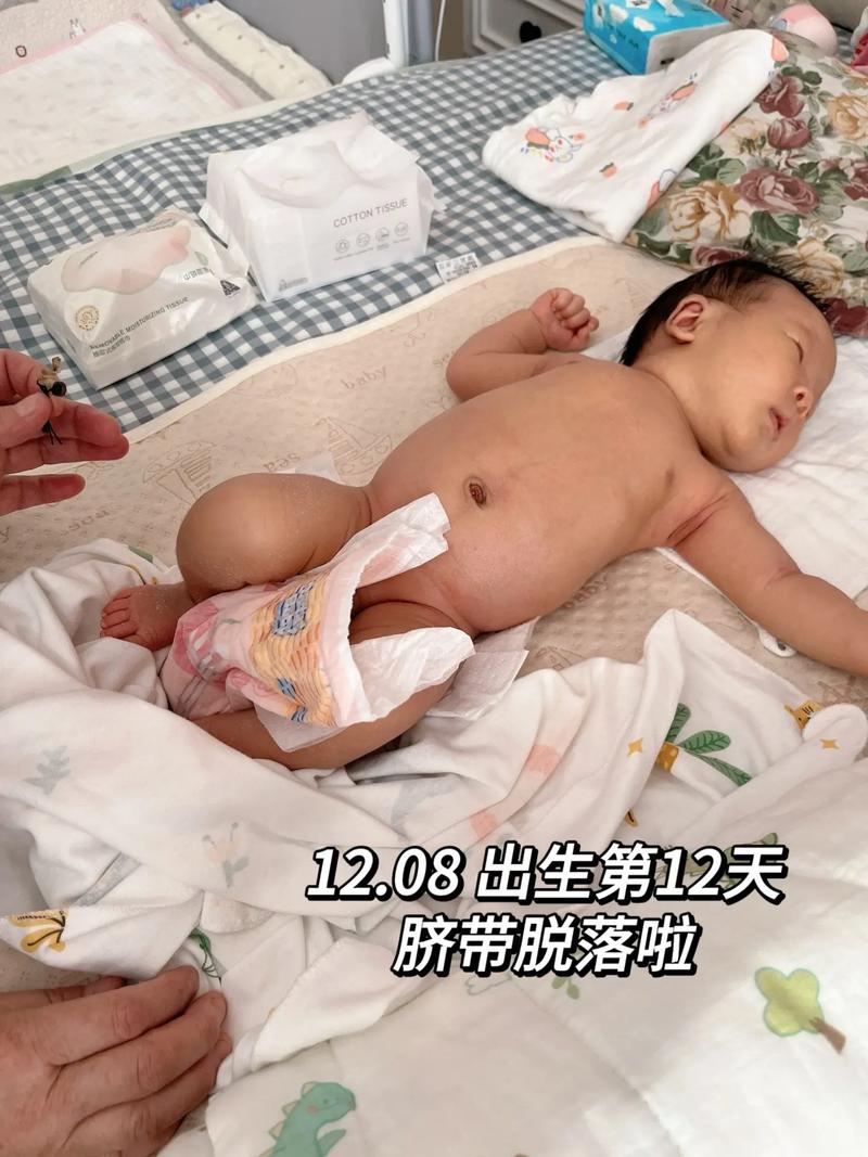 新生儿脐带脱落的征兆-第3张图片-郑州医学网