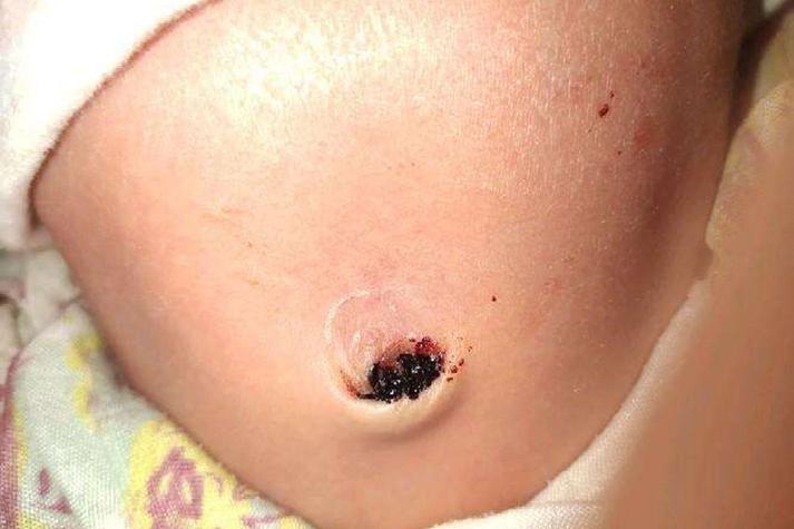 半个月新生儿肚脐出血,需要立即就医吗?还是在家护理就能止血?-第1张图片-郑州医学网 半个月新生儿肚脐出血,需要立即就医吗?还是在家护理就能止血?-第1张图片-郑州医学网