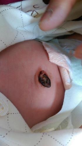 半个月新生儿肚脐出血,需要立即就医吗?还是在家护理就能止血?-第2张图片-郑州医学网 半个月新生儿肚脐出血,需要立即就医吗?还是在家护理就能止血?-第2张图片-郑州医学网