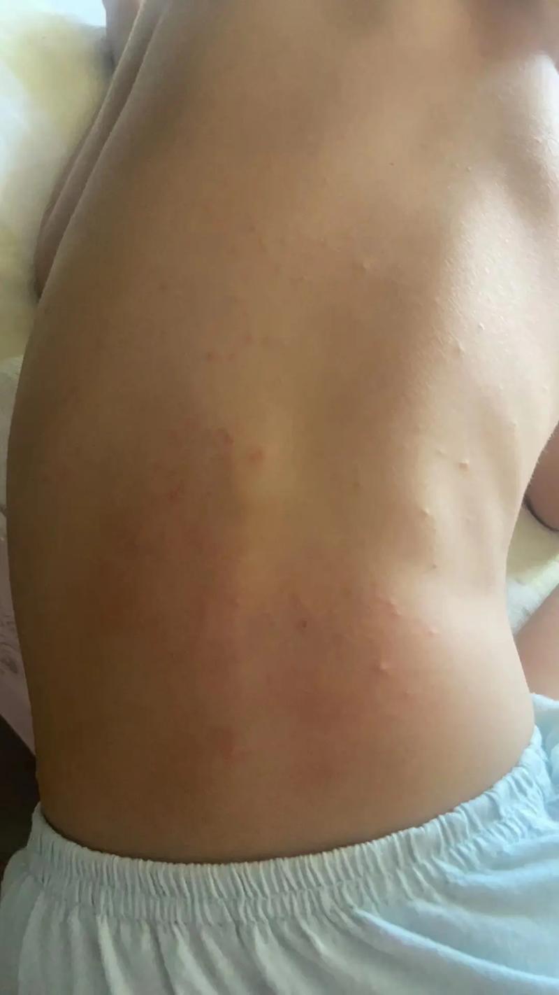 孩子背上突然冒出很多小疙瘩,是过敏了还是皮肤出问题了?-第1张图片-郑州医学网 孩子背上突然冒出很多小疙瘩,是过敏了还是皮肤出问题了?-第1张图片-郑州医学网