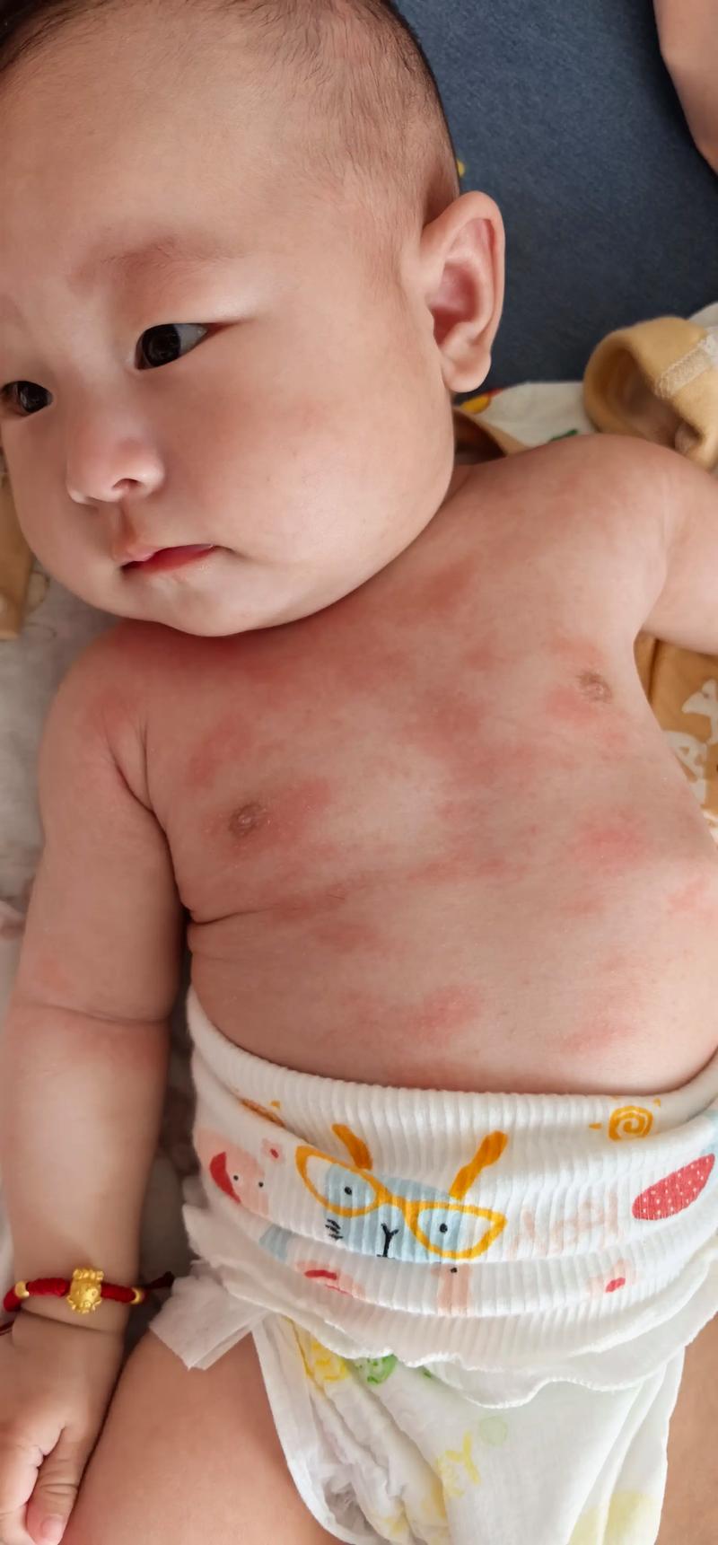 孩子背上突然冒出很多小疙瘩,是过敏了还是皮肤出问题了?-第2张图片-郑州医学网 孩子背上突然冒出很多小疙瘩,是过敏了还是皮肤出问题了?-第2张图片-郑州医学网