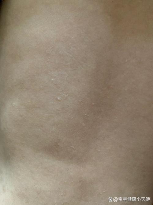 孩子背上突然冒出很多小疙瘩，是过敏了还是皮肤出问题了？-第3张图片-郑州医学网