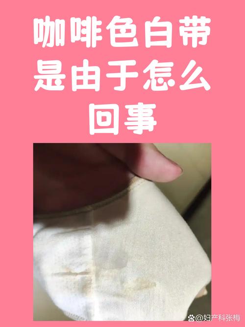 新生儿白带多是正常生理现象还是疾病信号？需关注哪些异常情况？-第3张图片-郑州医学网