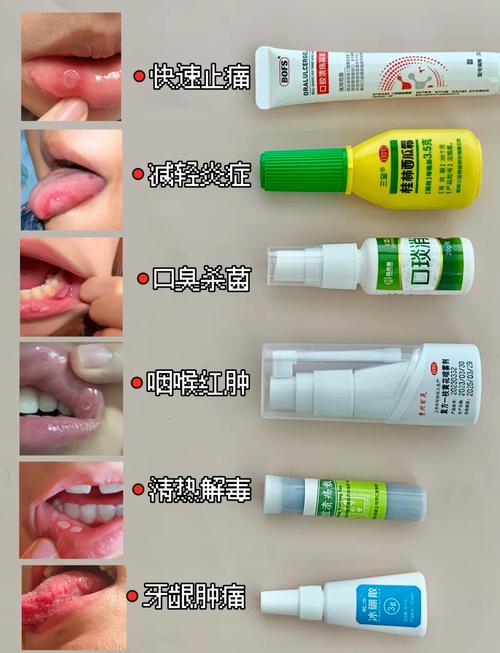 新生儿口腔溃疡的治疗-第2张图片-郑州医学网