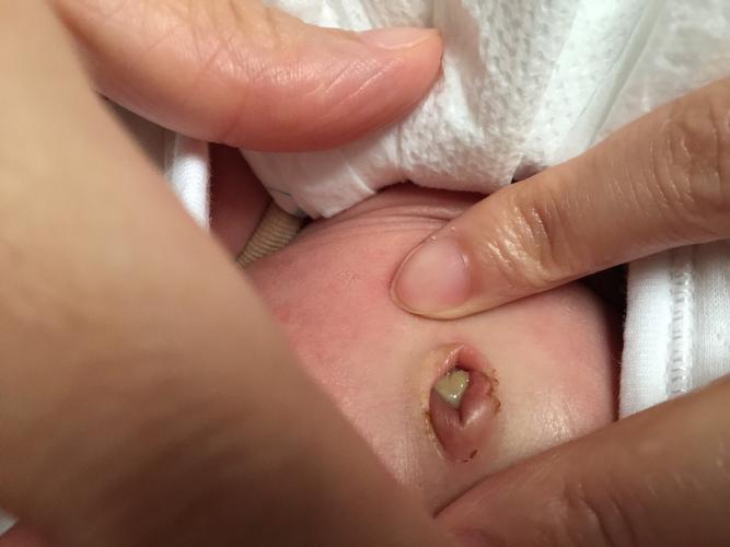 新生儿掉肚脐后出血是正常现象吗？需要立即处理吗？-第2张图片-郑州医学网