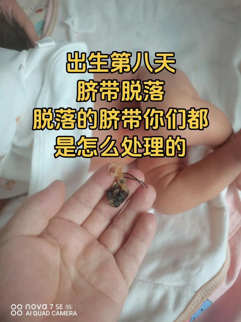 新生儿掉肚脐后出血是正常现象吗？需要立即处理吗？-第3张图片-郑州医学网
