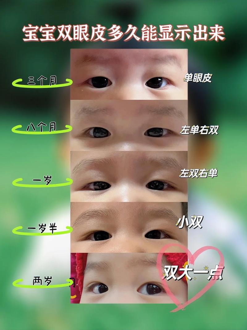 新生儿多久看出双眼皮-第1张图片-郑州医学网