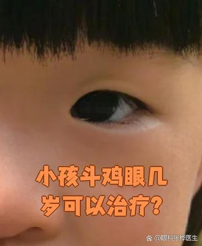 新生儿突然斗鸡眼僵直-第1张图片-郑州医学网