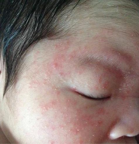 新生儿伤热有什么症状-第1张图片-郑州医学网