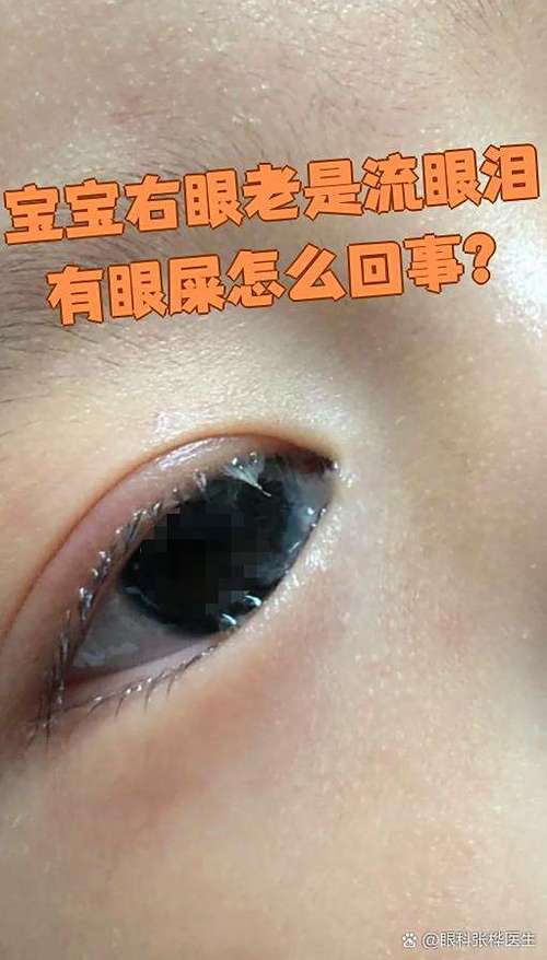 新生儿流黄眼泪、眼屎多是结膜炎吗？家长该如何正确护理和处理？-第2张图片-郑州医学网