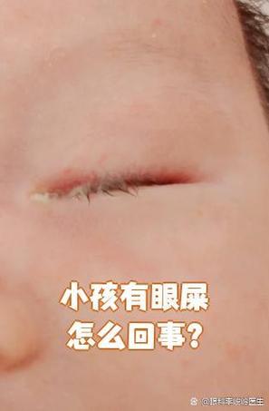 新生儿流黄眼泪、眼屎多是结膜炎吗？家长该如何正确护理和处理？-第3张图片-郑州医学网