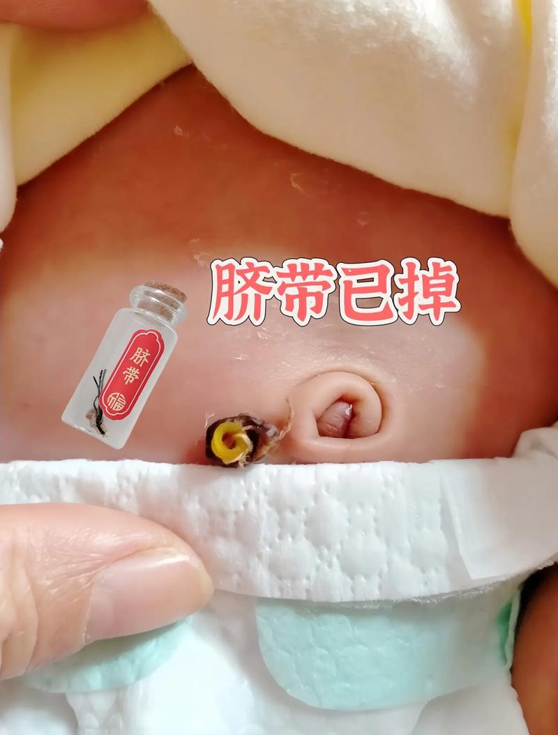 新生儿脐带问题该挂什么科?脐带护理不当需警惕哪些科室?-第2张图片-郑州医学网 新生儿脐带问题该挂什么科?脐带护理不当需警惕哪些科室?-第2张图片-郑州医学网