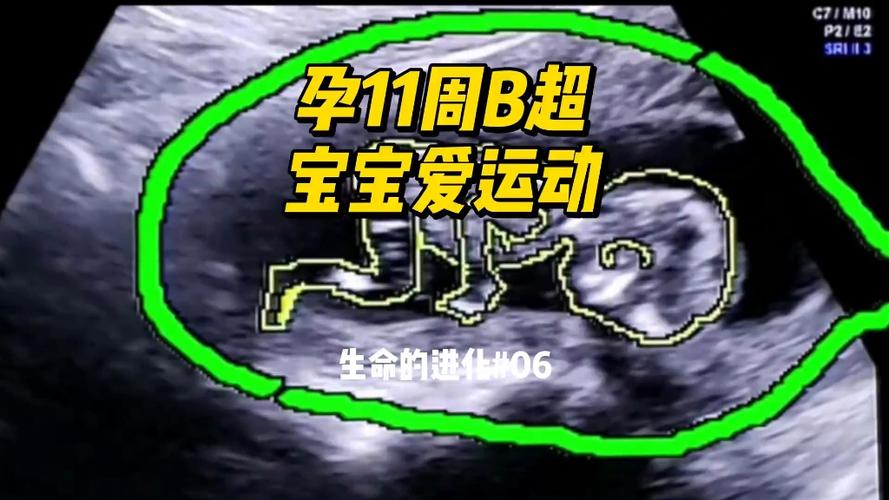 孕期十一周胎儿发育图显示哪些关键变化?此刻宝宝发育到什么程度了?-第1张图片-郑州医学网 孕期十一周胎儿发育图显示哪些关键变化?此刻宝宝发育到什么程度了?-第1张图片-郑州医学网