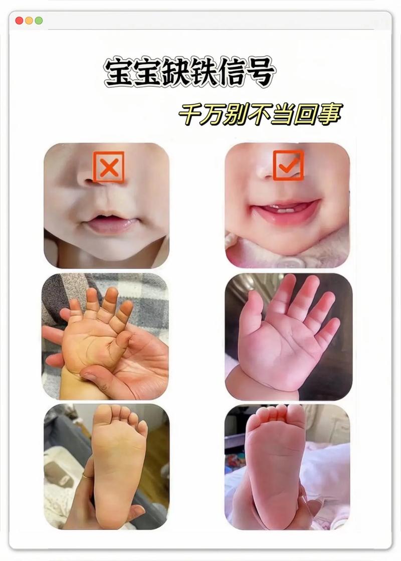 新生儿小拇指内弯是生理性还是病理性？需要干预吗？-第1张图片-郑州医学网