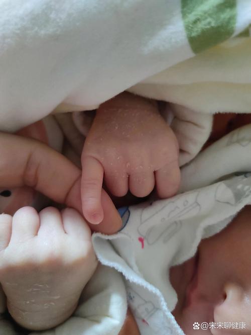 新生儿小拇指内弯是生理性还是病理性？需要干预吗？-第2张图片-郑州医学网