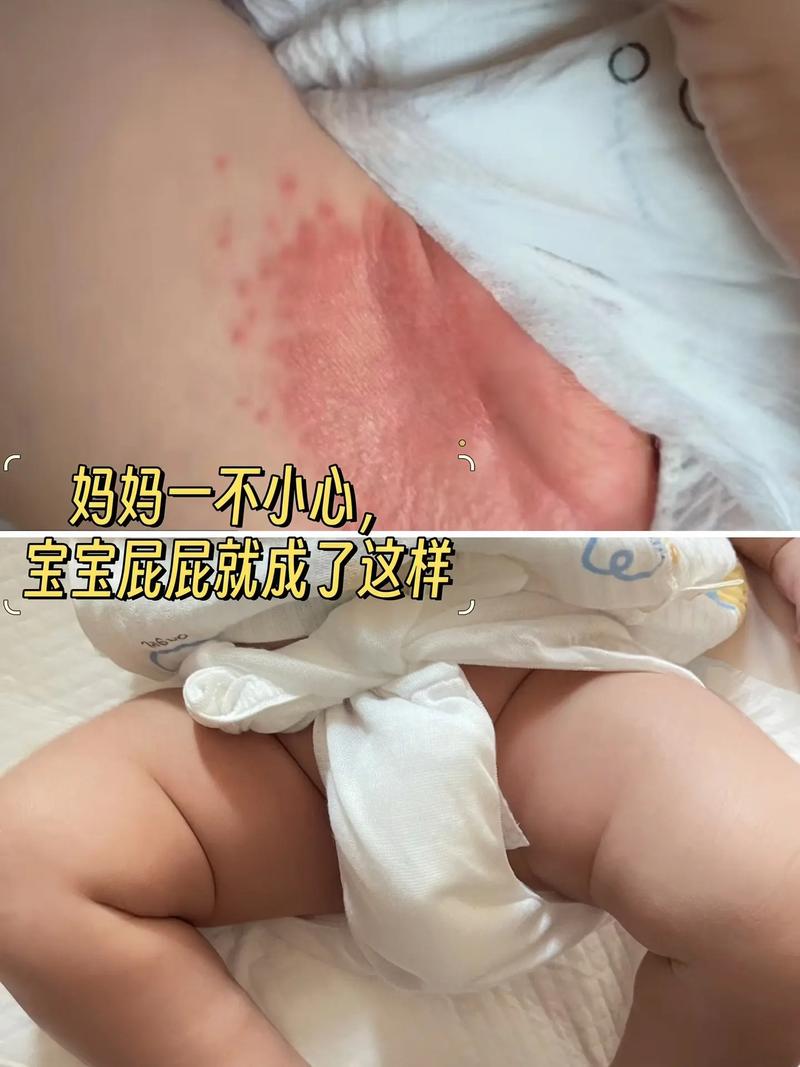 新生儿屁股红是因为拉屎次数多还是护理方式不对？-第1张图片-郑州医学网