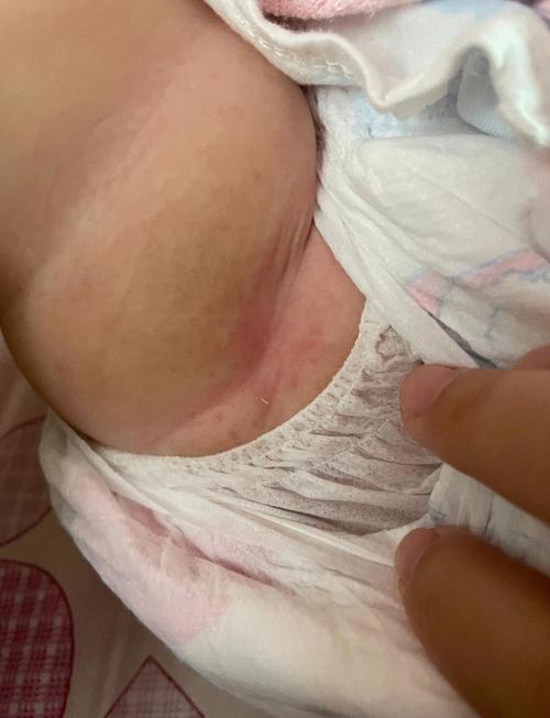 新生儿屁股红是因为拉屎次数多还是护理方式不对？-第2张图片-郑州医学网