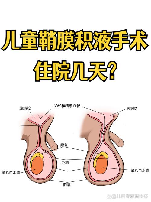 儿童鞘膜积液的最佳手术时间是什么时候？需要根据年龄、症状和积液情况综合判断吗？-第3张图片-郑州医学网