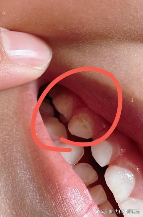 龋齿图片儿童牙齿发黑-第1张图片-郑州医学网 龋齿图片儿童牙齿发黑-第1张图片-郑州医学网