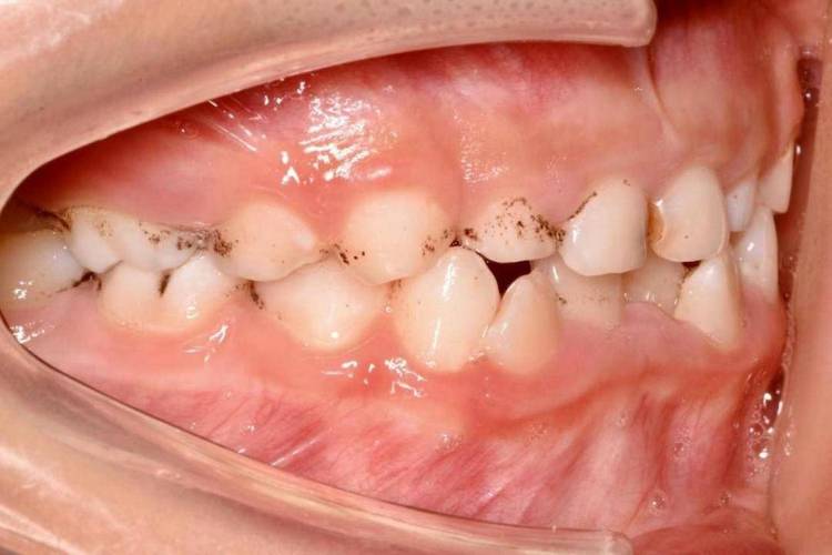 龋齿图片儿童牙齿发黑-第2张图片-郑州医学网 龋齿图片儿童牙齿发黑-第2张图片-郑州医学网