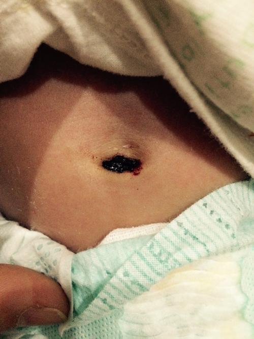 新生儿肚脐脱落后出血正常吗?需要处理吗?-第2张图片-郑州医学网 新生儿肚脐脱落后出血正常吗?需要处理吗?-第2张图片-郑州医学网