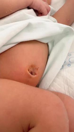 新生儿肚脐脱落后出血正常吗？需要处理吗？-第3张图片-郑州医学网