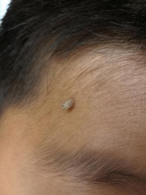 儿童病毒性疣早期图片有哪些典型特征？如何与普通皮疹区分？-第2张图片-郑州医学网