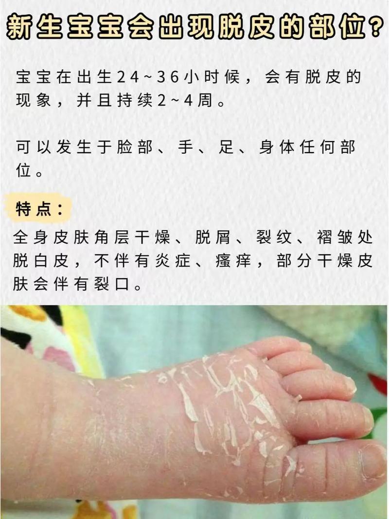 新生儿脱皮要怎么护理-第1张图片-郑州医学网